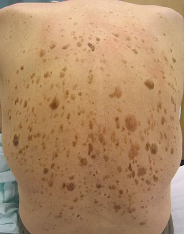 senile wart: seborrheic keratosis