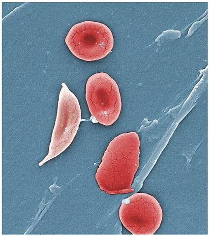 sickle cell: an abnormal erythrocyte (red blood cell) that has a crescent shape, characteristic of sickle-cell...