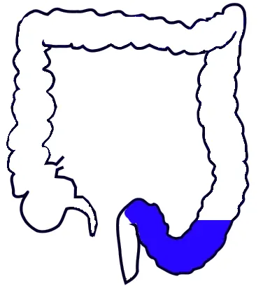 sigmoid colon: the S-shaped section of the large intestine between the descending colon and the rectum