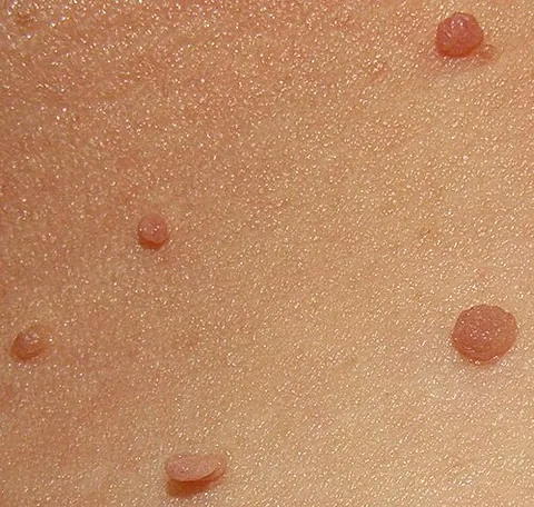 skin tag: synonym of acrochordon