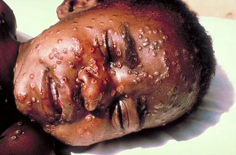 smallpox: an acute, highly infectious often fatal disease caused by Variola virus of the family Poxviridae....