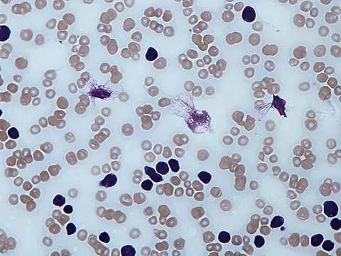 smudge cell: cell remnant, most often seen with abnormally fragile lymphocytes in afflictions such as chronic...