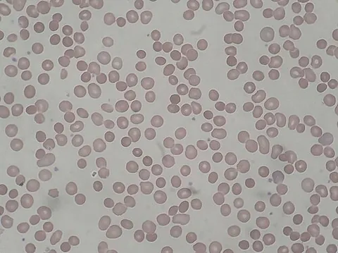 spherocyte: a red blood cell that is spherical rather than biconcave, as occurs in spherocytosis