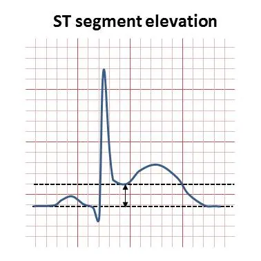 st elevation: a finding on an echocardiogram where the ST segment is raised above the baseline in one or more...