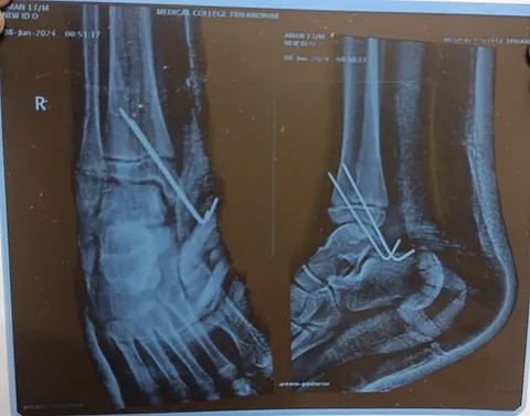 stable fixation: the act of securely holding broken bones in correct alignment using casts, braces, plates, screws,...