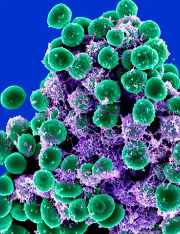 staphylococcus: a spherical gram-positive parasitic bacterium of the genus Staphylococcus, causing blisters,...