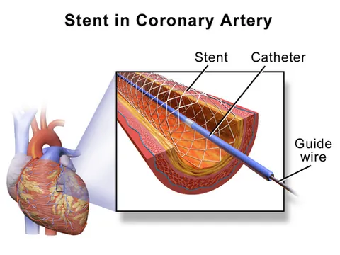 stent: a slender tube inserted into a blood vessel, a ureter or the oesophagus in order to provide support...