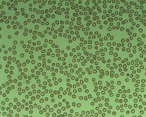 stomatocyte: erythrocyte with an oval or rectangular central pallor
