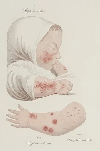 strophulus: an eruption of red pimples upon the face, neck, and arms, in early infancy