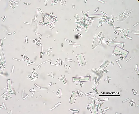 struvite: a hydrated magnesium-containing mineral Mg(NH₄)(PO₄)·6H₂O which is found in kidney stones...