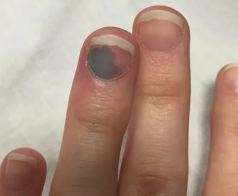 subungual hematoma: is a collection of blood (hematoma) underneath a toenail or fingernail. It can be extremely painful...