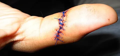 suture: a seam formed by sewing two edges together, especially to join pieces of skin in surgically...