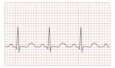 tachycardia: a rapid resting heart rate, especially one above 100 beats per minute; palpitations