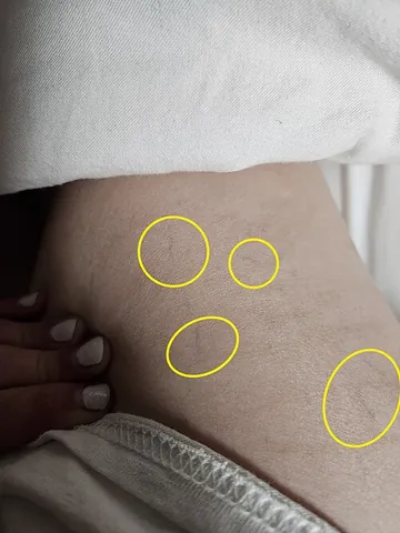 telangiectasia: a condition characterized by dilatation of the capillaries, causing them to appear as small red or...