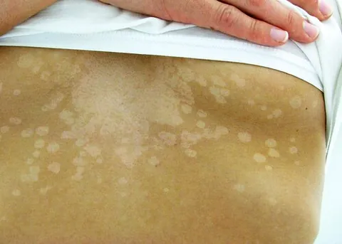 tinea versicolor: a skin condition of a yeast infection causing discoloured patches on the trunk and proximal...