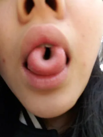 tongue rolling: the ability to roll the lateral edges of one's tongue upwards into a tube, widely believed to be a...