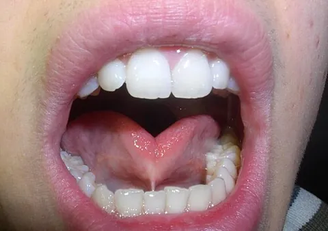 tongue-tied: having tongue-tie or ankyloglossia (“a congenital oral anomaly in which the lingual frenulum (a...