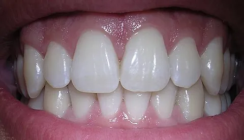 tooth: a hard, calcareous structure present in the mouth of many vertebrate animals, generally used for...