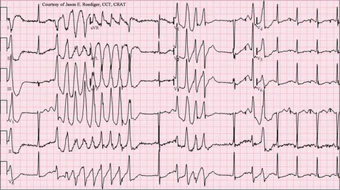 torsades de pointes: a polymorphic ventricular tachycardia, predisposing to sudden cardiac death and more likely to...