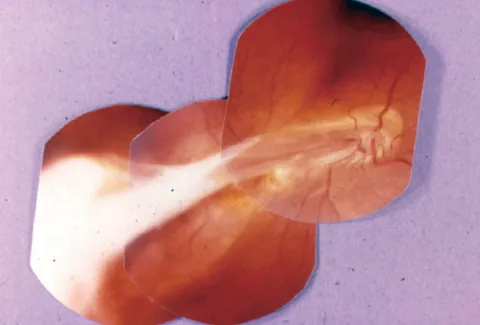 toxocariasis: a zoonotic, helminthic infection of humans caused by roundworms of the genus Toxocara