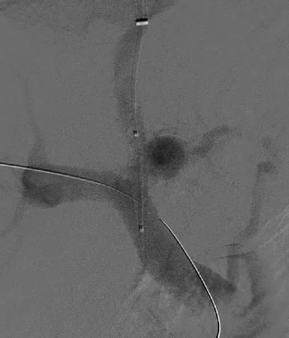 transjugular intrahepatic portosystemic shunt: a minimally invasive interventional radiology procedure in which a stent is placed within the liver...