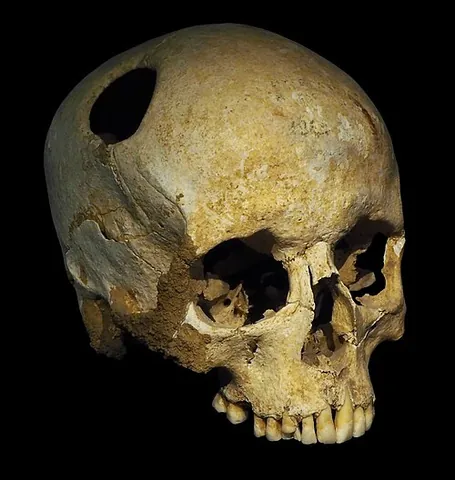 trepanation: the practice of drilling a hole in the skull as a physical, mental, or spiritual treatment