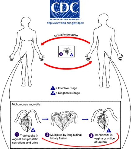 trichomoniasis: a common sexually transmitted disease caused by the parasite Trichomonas vaginalis and infecting...