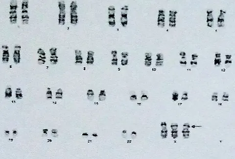 triple x syndrome: a form of chromosomal variation characterized by the presence of an extra X chromosome in each cell...