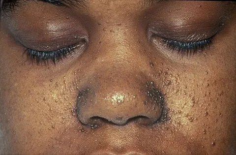 tuberous sclerosis: a rare disease that causes benign tumors to grow in the human brain, kidneys, heart, liver, eyes,...