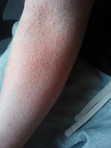 urticaria: itchy, swollen, red areas of the skin which can appear quickly in response to an allergen or other...