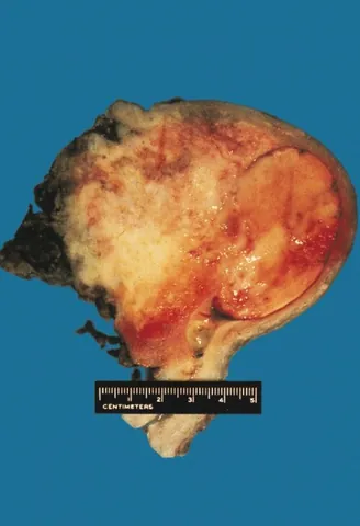 uterine cancer: any of certain cancers that occur in the uterus, excluding cervical cancer; their principal...