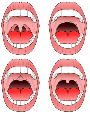 uvulopalatopharyngoplasty: a surgical procedure used to remove tissue in the throat in order to widen the airway of the...