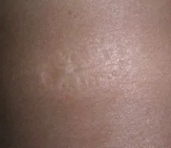 vaccination mark: a small scar left on the skin by vaccination