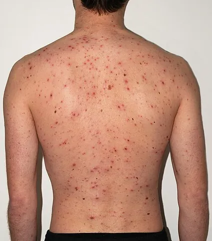 varicella: an acute, highly contagious pathogenic disease caused by the varicella zoster virus, primarily...