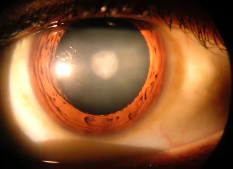 vitreoretinochoroidopathy: a rare eye disorder that affects the vitreous, retina, and choroid. It can be caused by bestrophin...