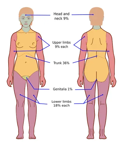 wallace rule of nines: a tool used in prehospital and emergency medicine to estimate the total body surface area affected...