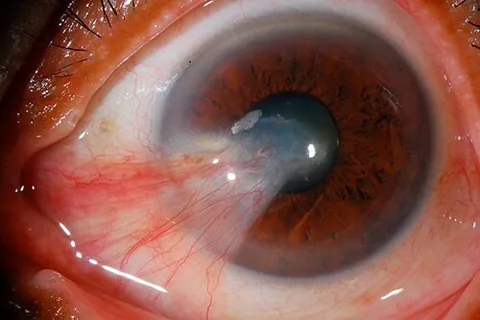 webeye: a superficial growth of vascular tissue radiating from the cornea over the surface of the eye