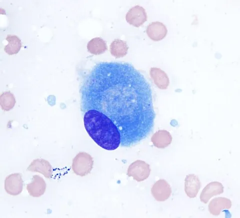 wright-giemsa stain: a cytological stain used primarily for metaphase chromosomes and differentiation of blood cells