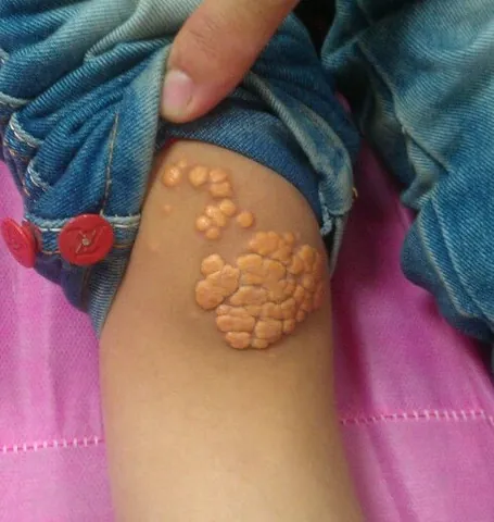 xanthoma: a small, yellow nodule, rich in cholesterol and other lipids, that occurs in the skin, often near a...