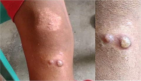 yaws: a contagious tropical disease, caused by the spirochete Treponema pertenue, characterized by...